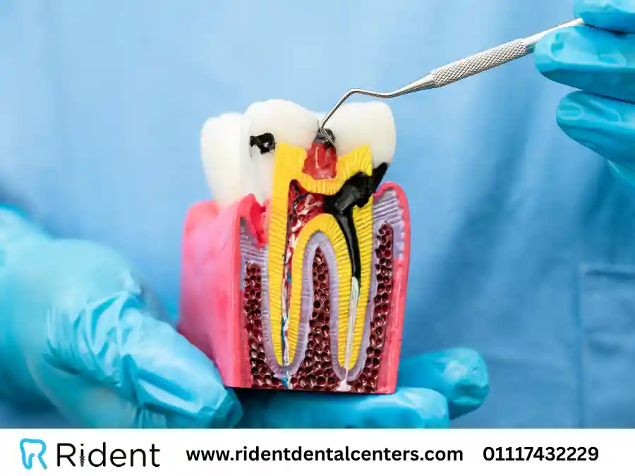 علاج عصب الاسنان